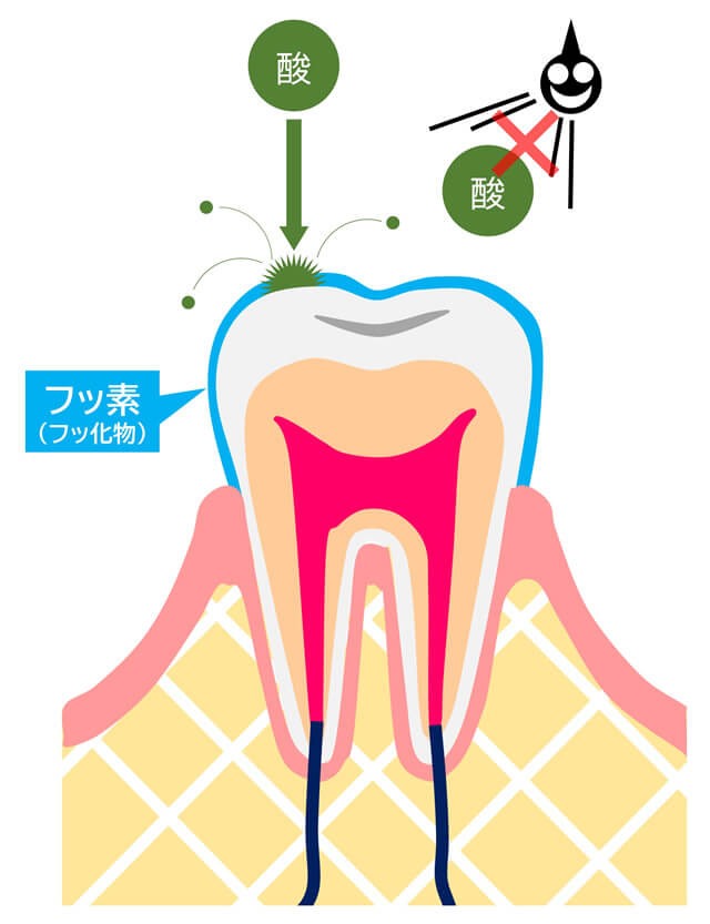 フッ素塗布