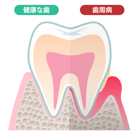 歯周病について